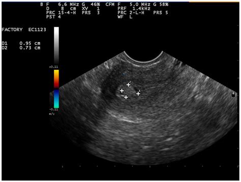 uterine polyp impact blood test|round polyps in uterus.